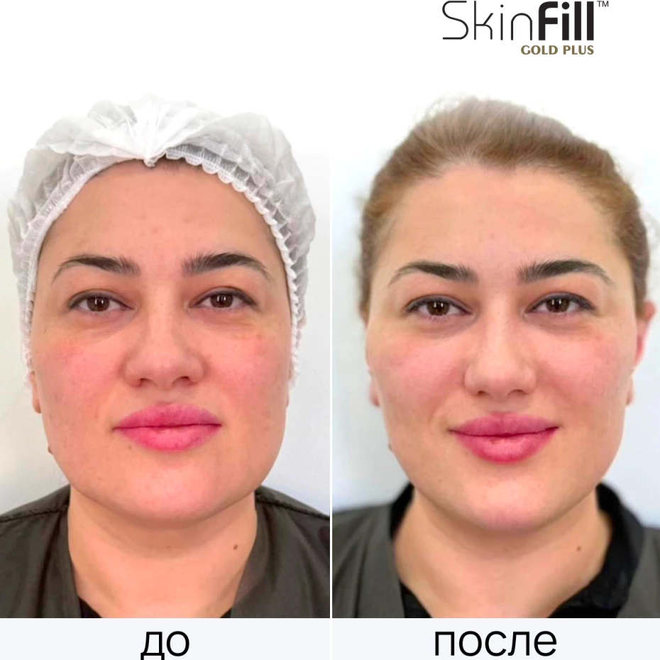 Дермальный филлер SkinFill Gold Plus (20 мг/мл)