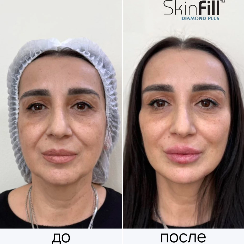 Дермальный филлер SkinFill Diamond Plus (25 мг/мл)