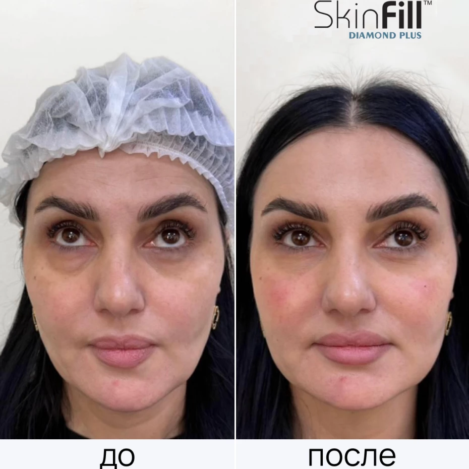 Дермальный филлер SkinFill Diamond Plus (25 мг/мл)